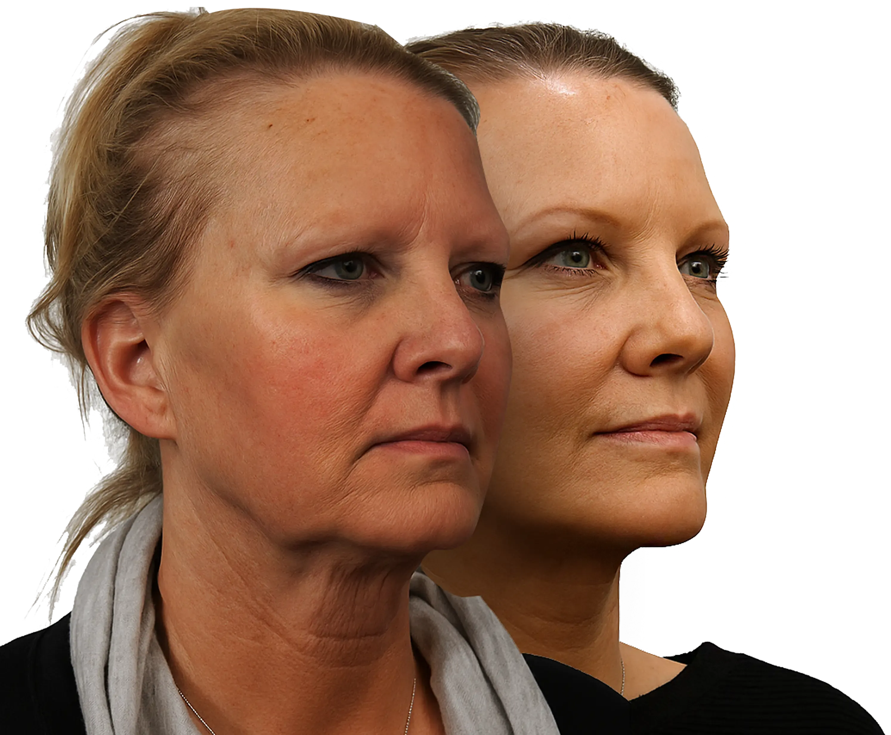 Elastase The Skin-Sagging Enzyme