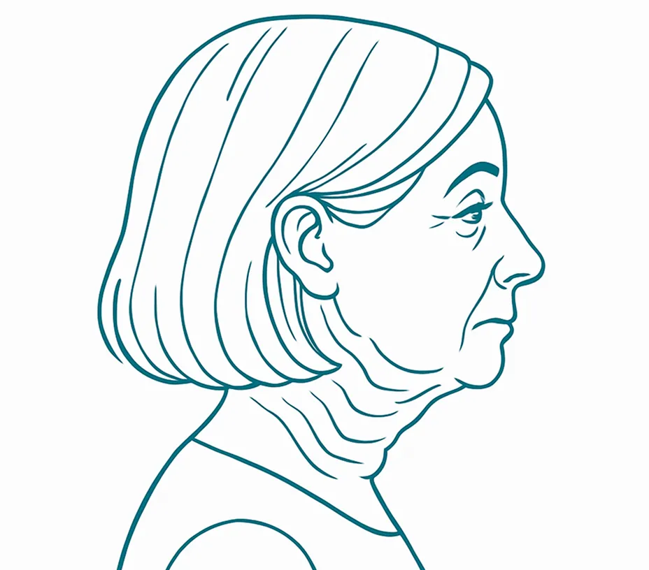 Sagging Jowls, Turkey Neck, Or Deep Lines