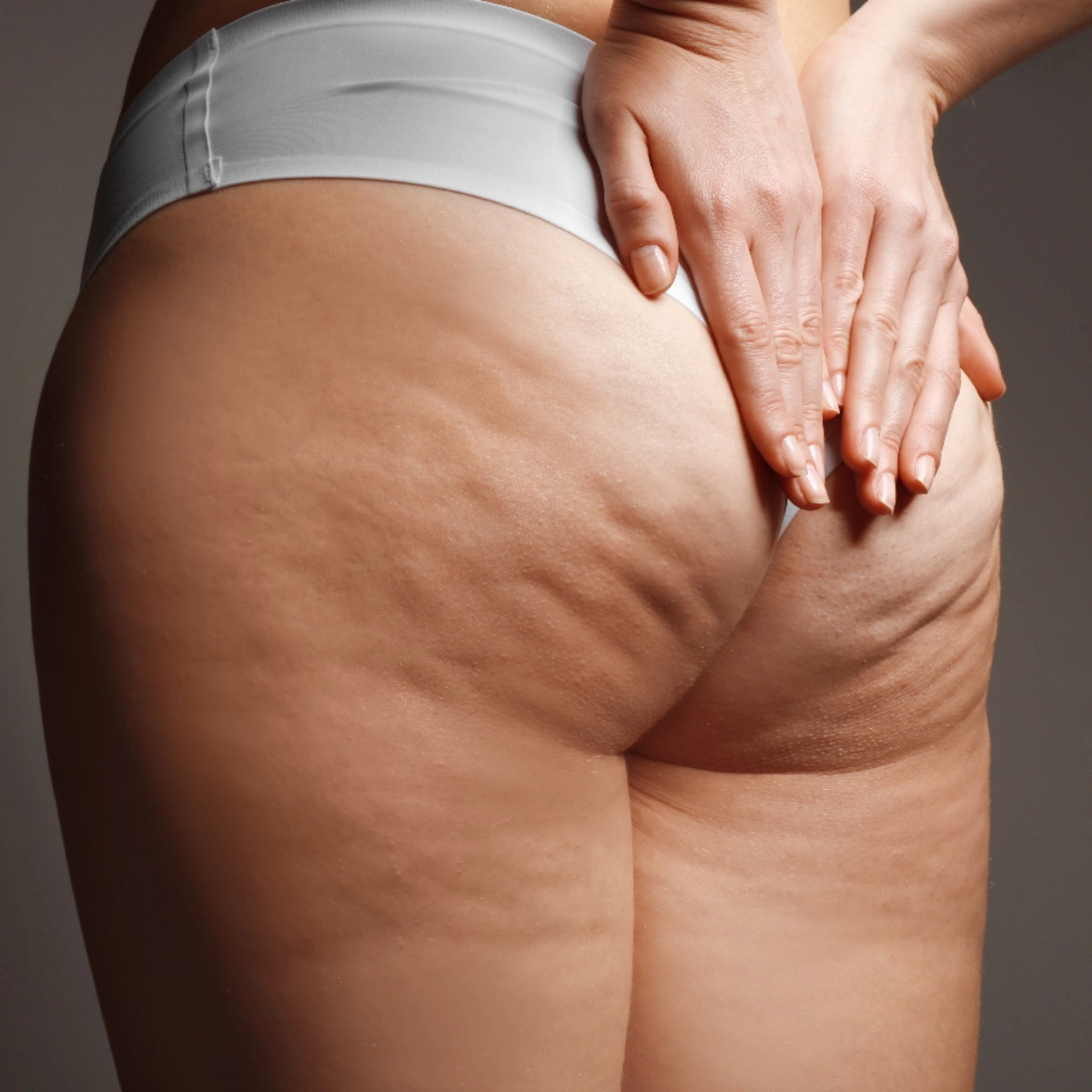 More Visible Cellulite