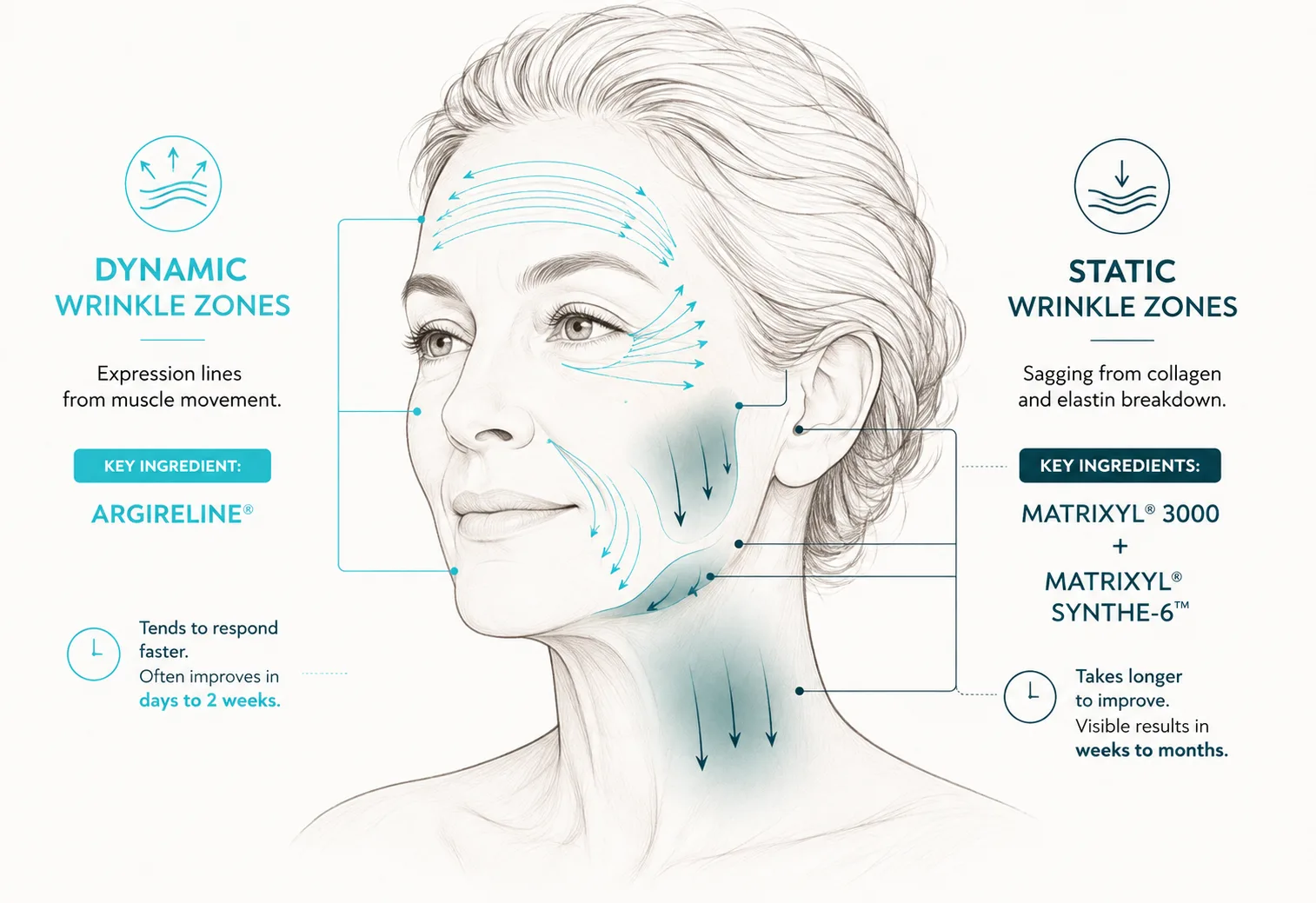 Illustration of a face showing dynamic wrinkle zones at the forehead, eyes and smile lines, and static wrinkle zones at the cheeks, jowls and neck.